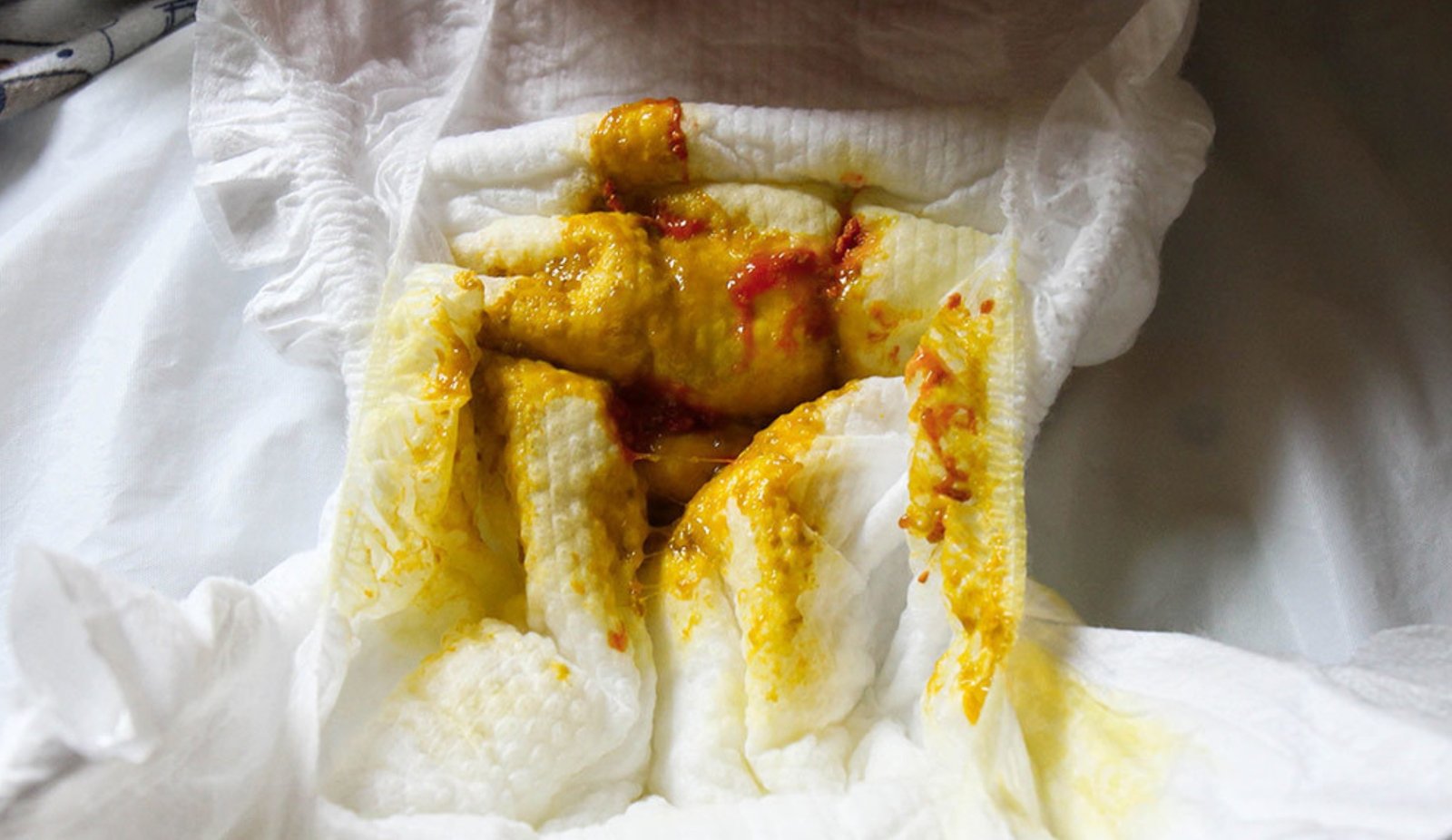 Blood Stool in Newborns