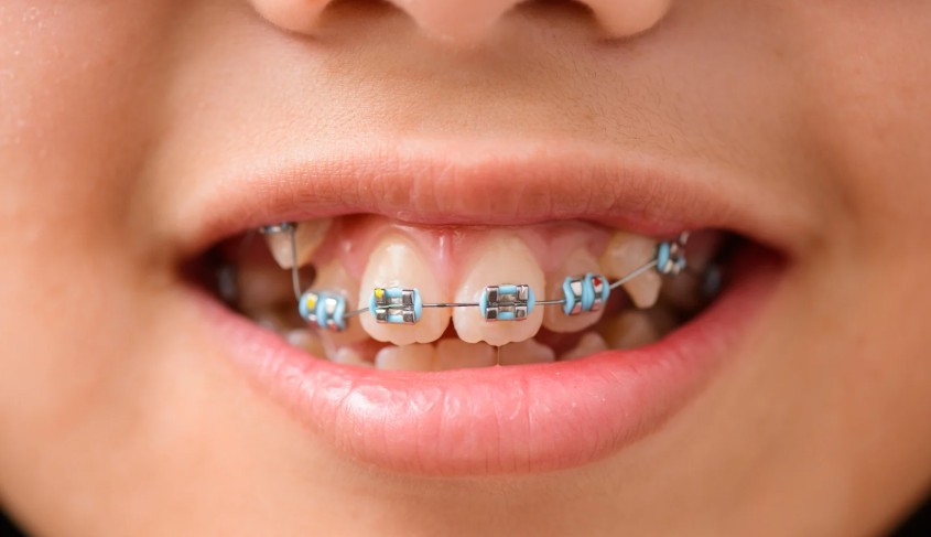 how many teeth does a teenager have