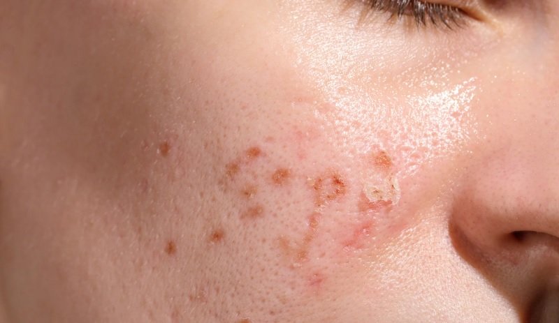 Can ADHD Meds Make Dermatillomania Worse