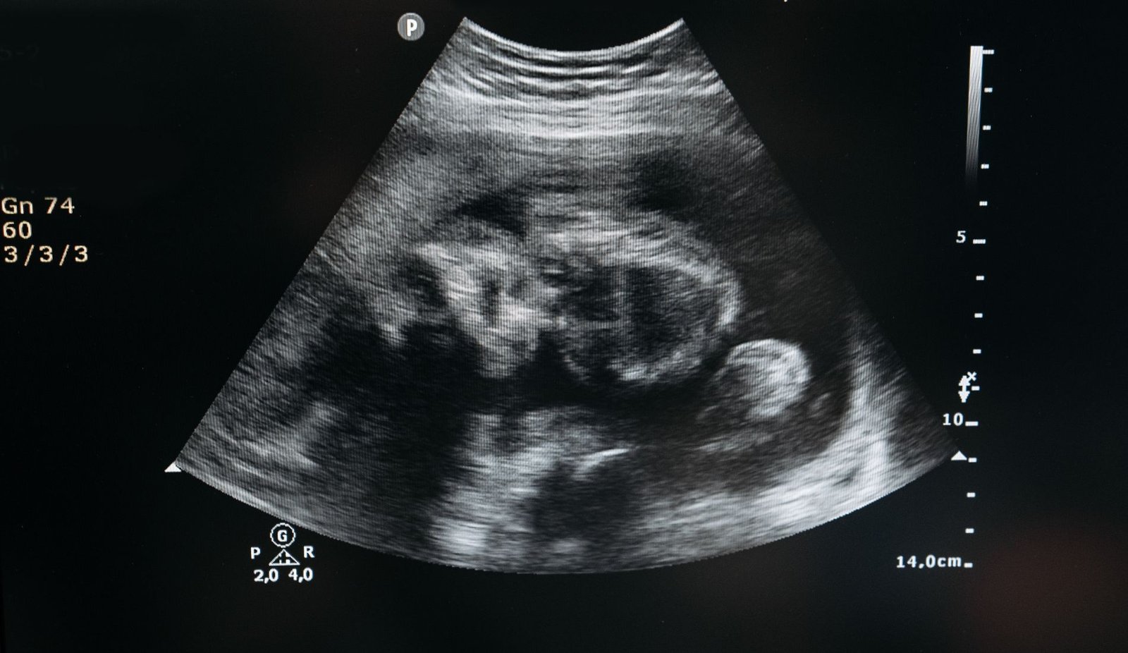 Cornual Ectopic Pregnancy