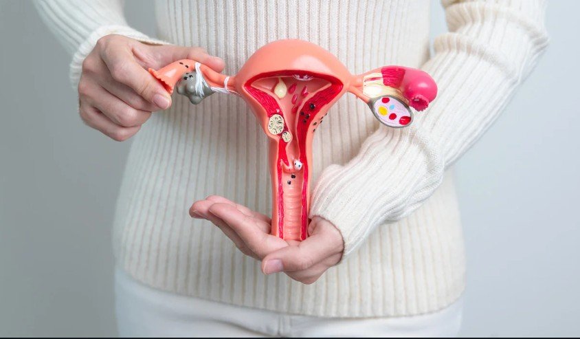 Endometriosis and Ectopic Pregnancy Ectopic Pregnancy and Endometriosis