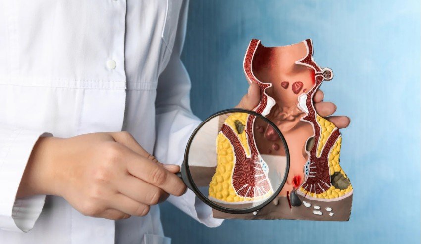 Hemorrhoids Postpartum Cure