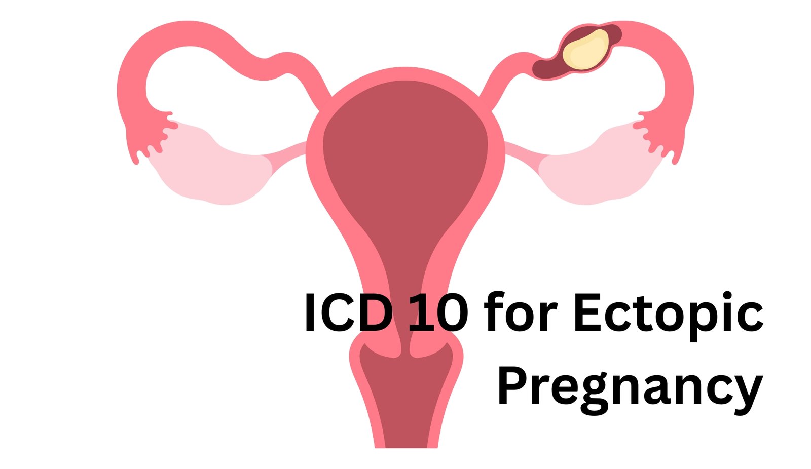 ICD 10 for Ectopic Pregnancy