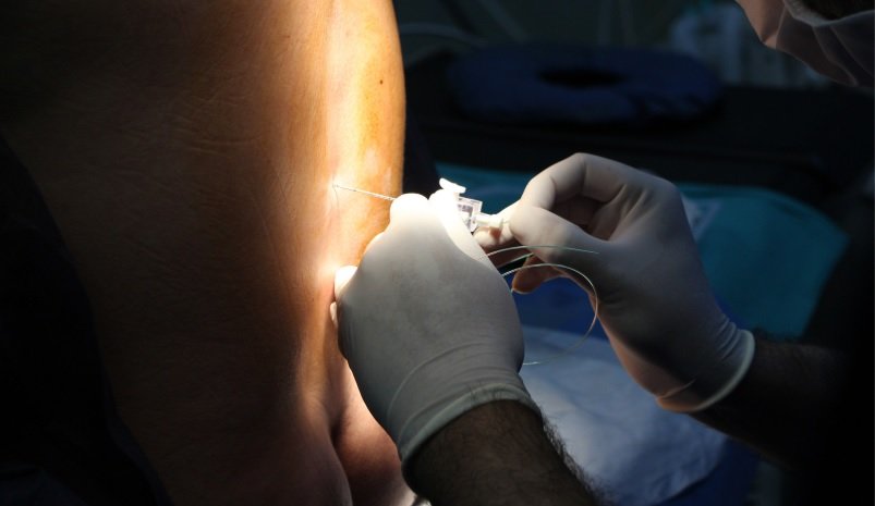 Long Term Side Effects of Epidural