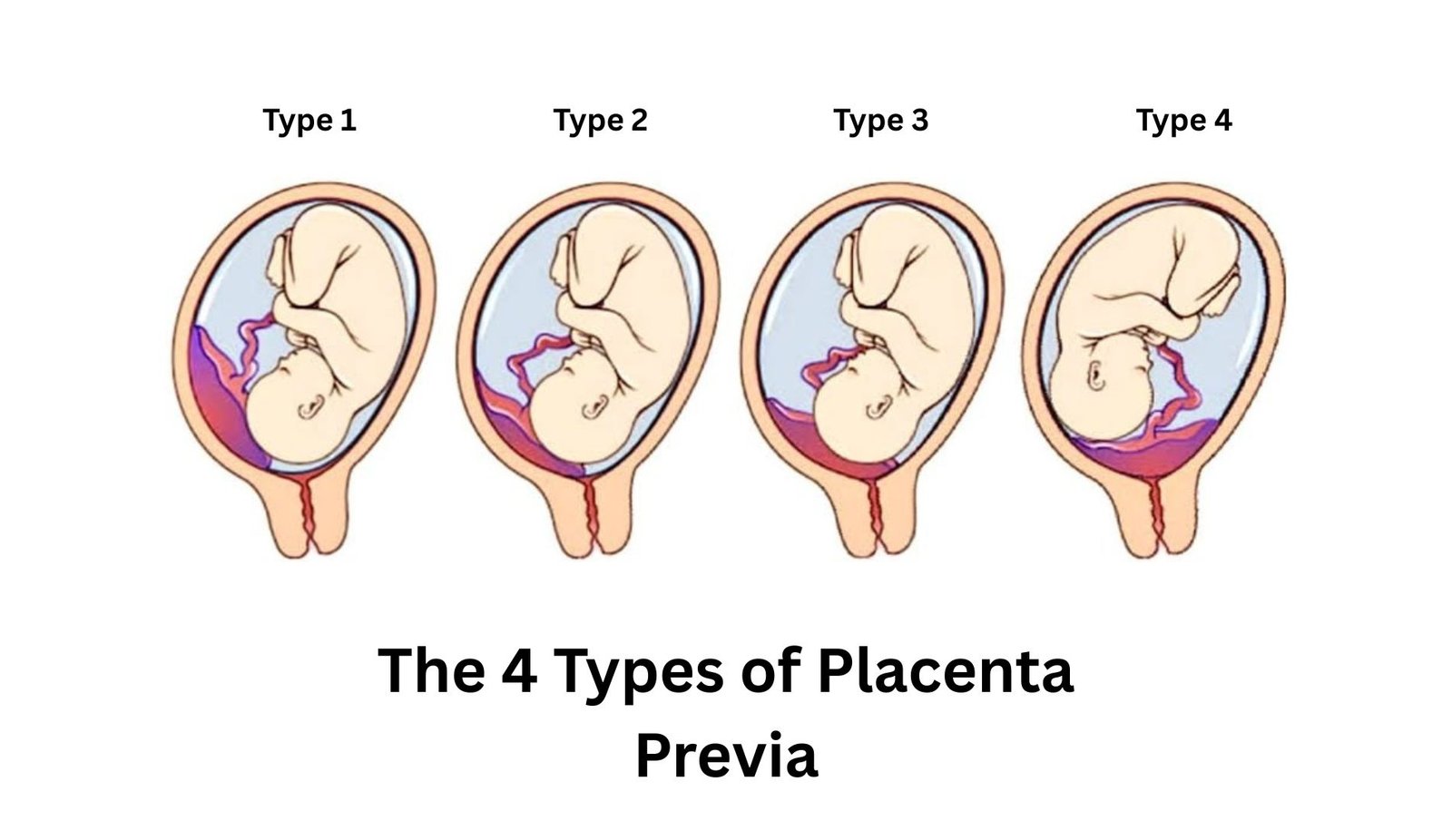 4 Types of Placenta Previa