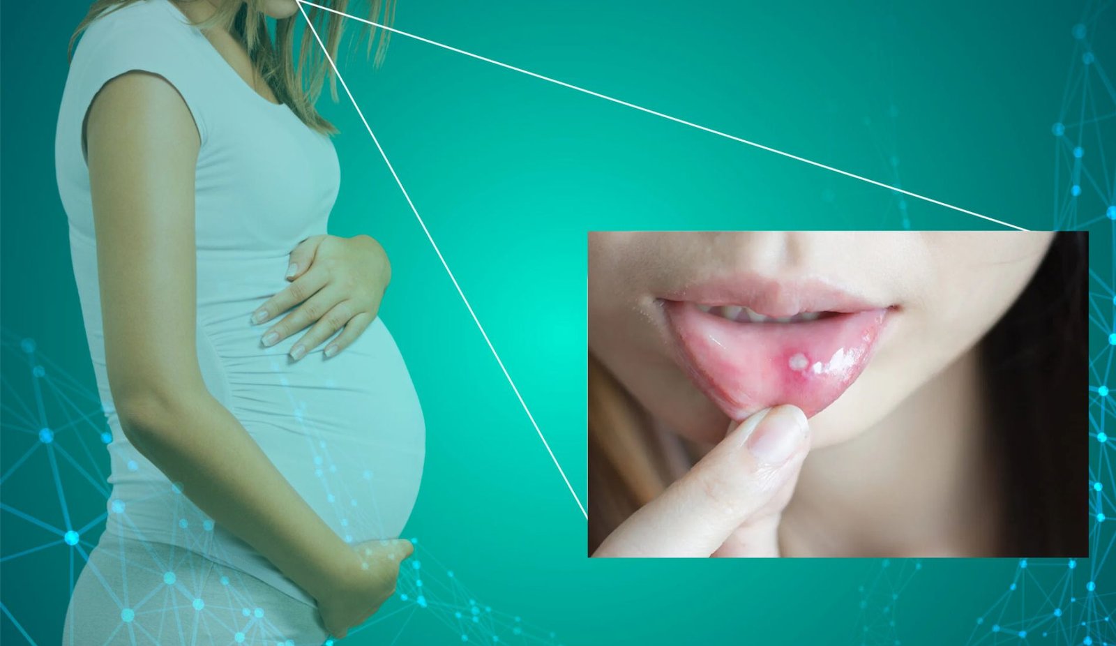 Canker Sore During Pregnancy