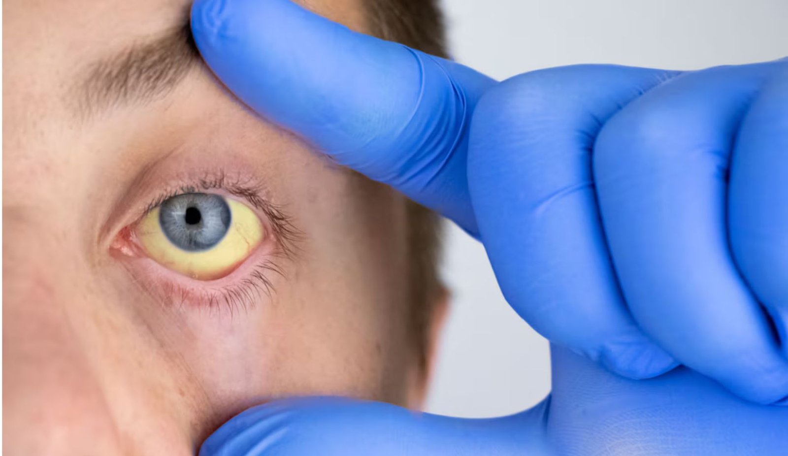 Iron Deficiency Eyes Symptoms