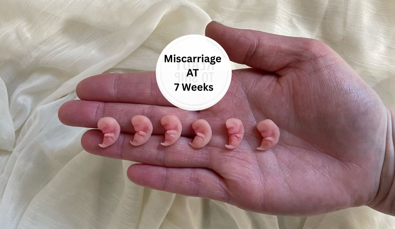 Miscarriage Real Life 7 Week Fetus
