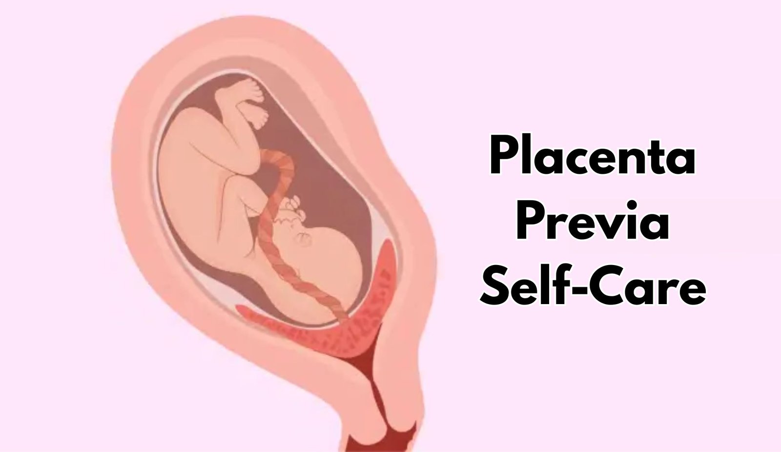 Placenta Previa Self-Care