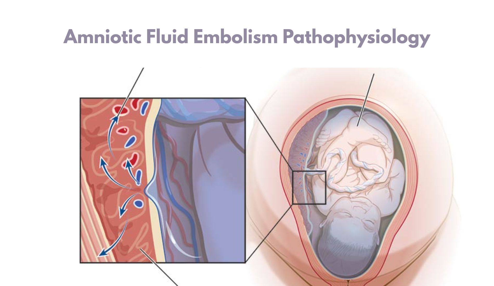 Amniotic Fluid Embolism Pathophysiology