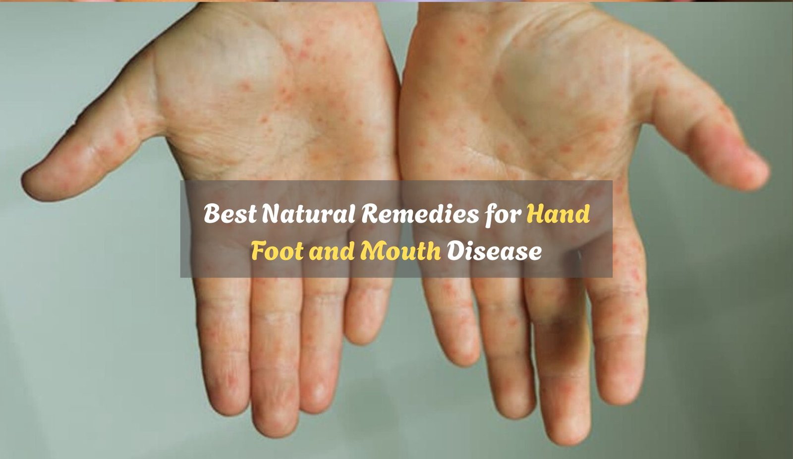 Natural Remedies for Hand Foot and Mouth Disease