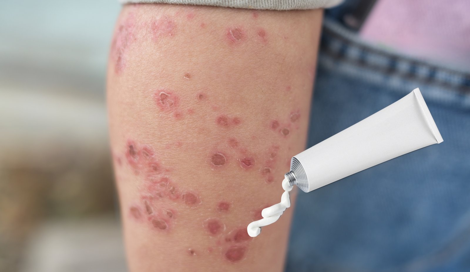 Best Ointment for Hand Foot and Mouth Disease