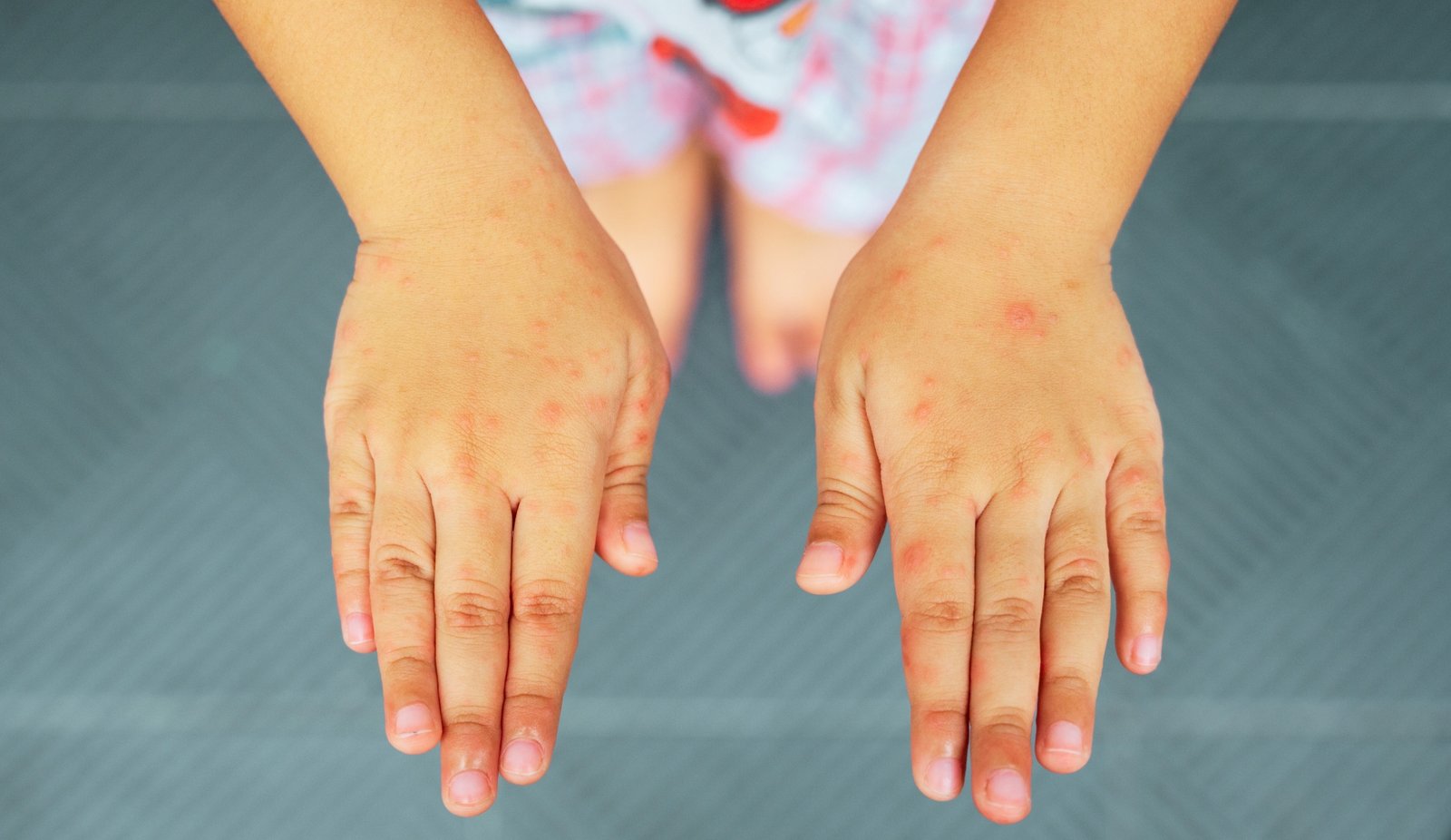 Can Adults Get Hand Foot and Mouth