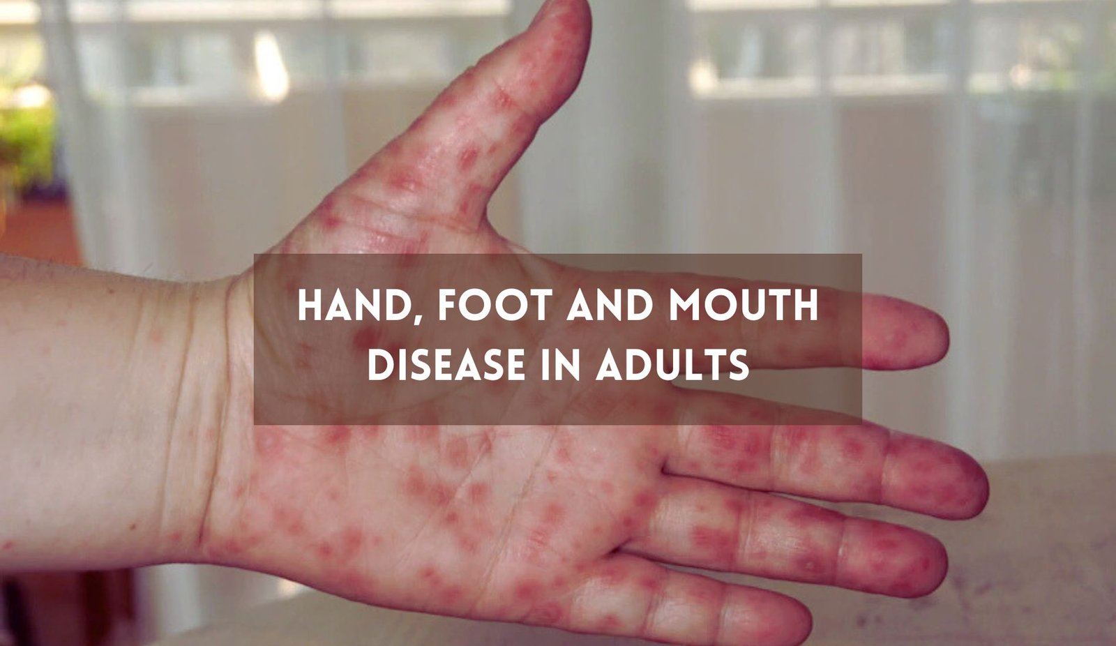 Hand Foot and Mouth Disease in Adults