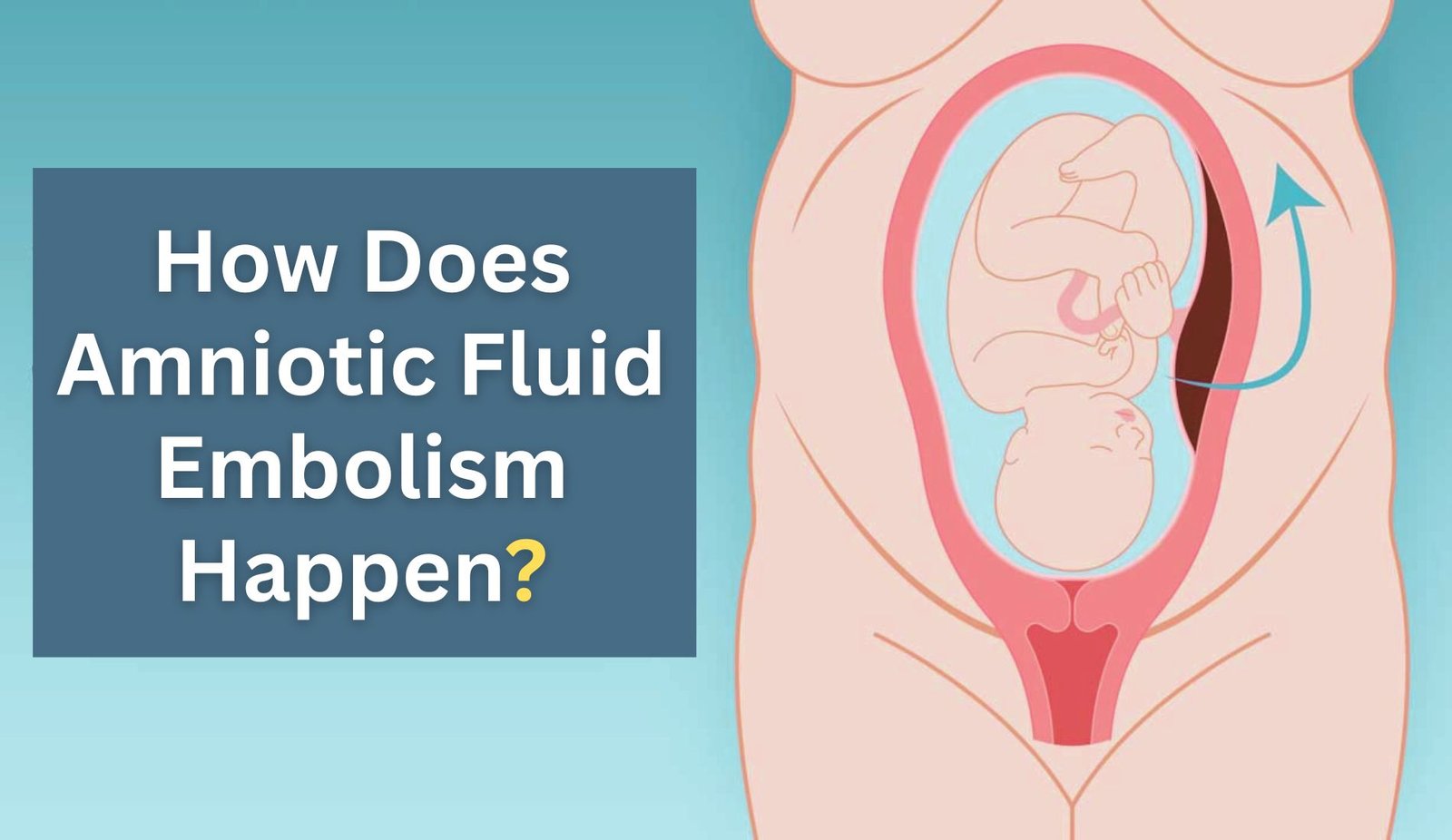 How Does Amniotic Fluid Embolism Happen