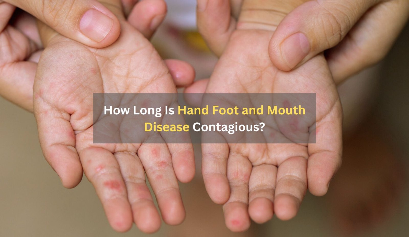 How Long Is Hand Foot and Mouth Disease Contagious