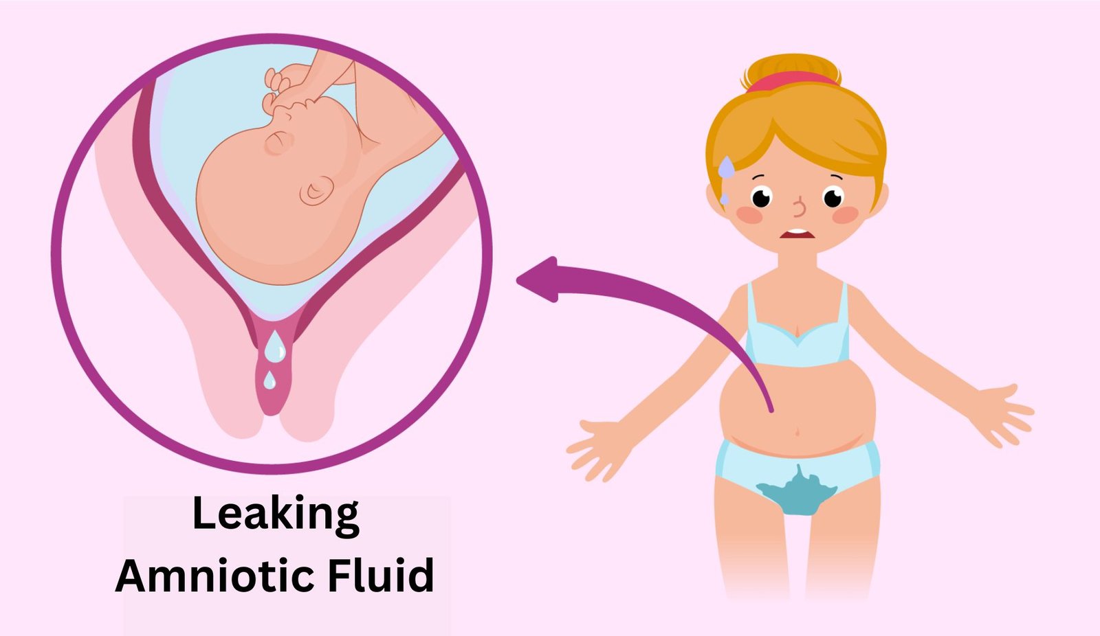 Leaking Amniotic Fluid in Pregnancy