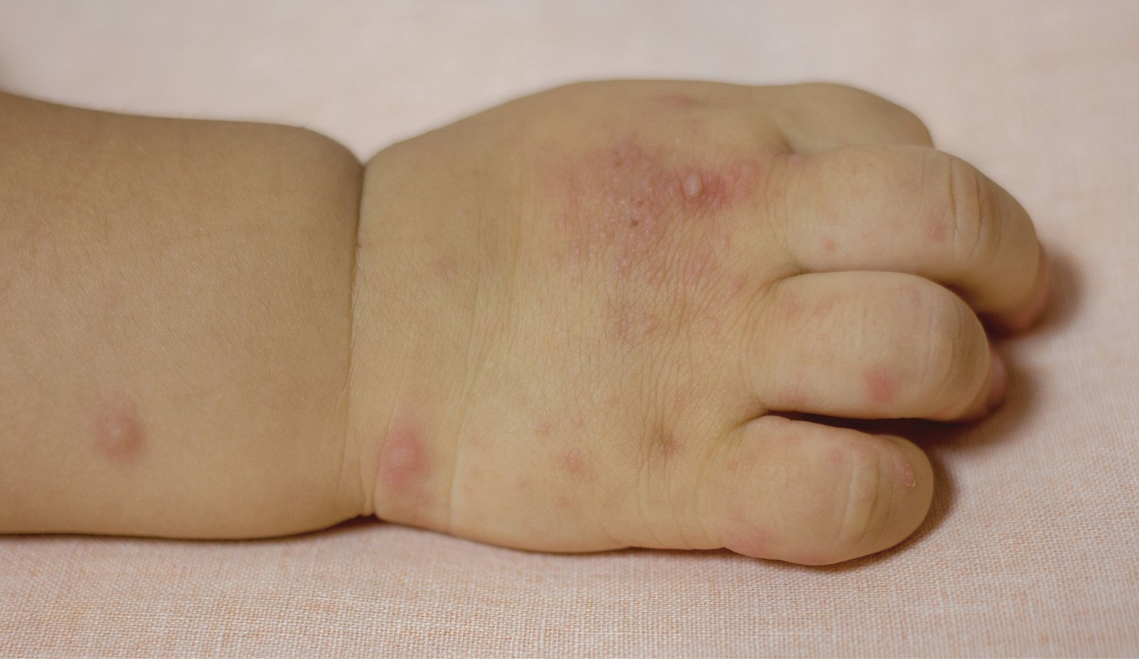 What Are the Causes of Hand Foot and Mouth Disease