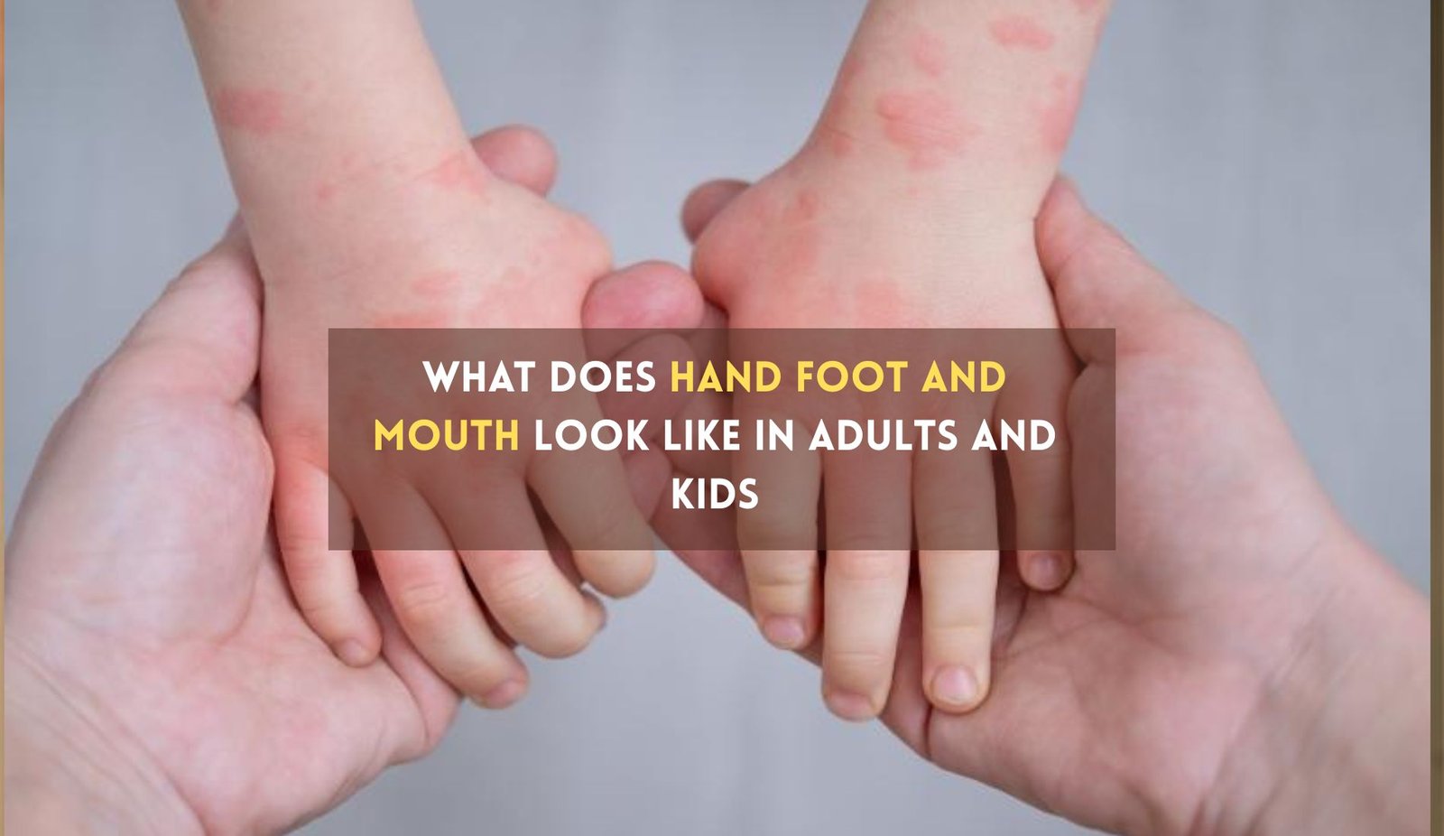 What Does Hand Foot and Mouth Look Like in kids and Adults